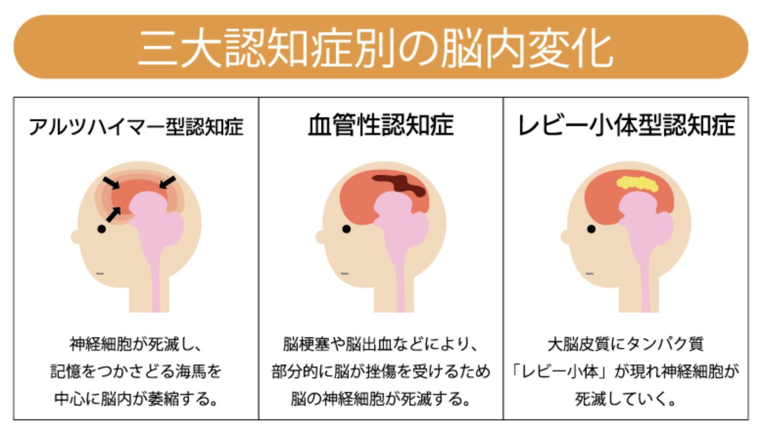 三大認知症の脳内変化