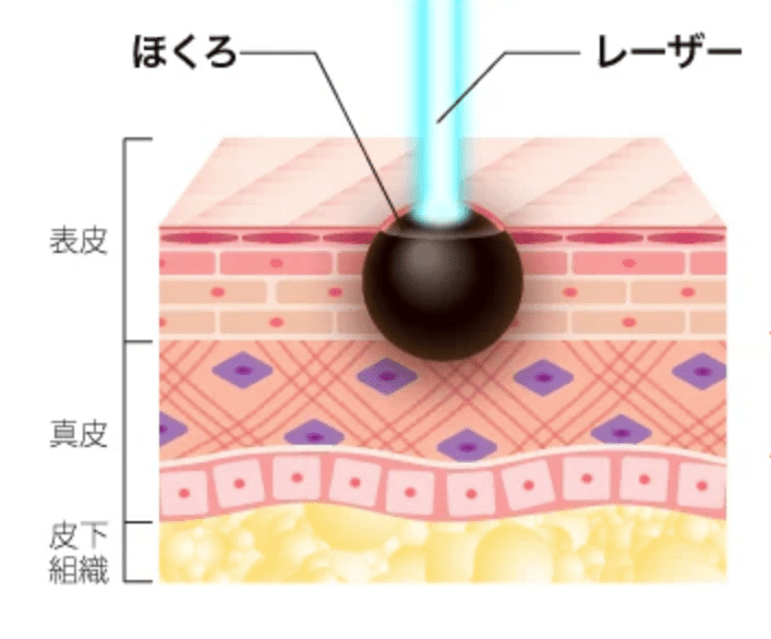 ほくろ除去の値段相場は？クリニックの平均価格とコスパの良い方法をご紹介！